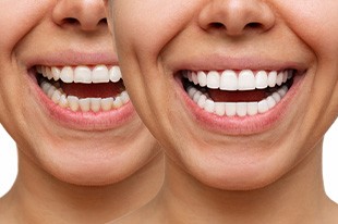 Nose-to-neck before/after pictures of cosmetic dental procedure results