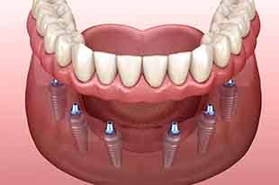 Example of implant dentures at Deer Park Family Dentistry